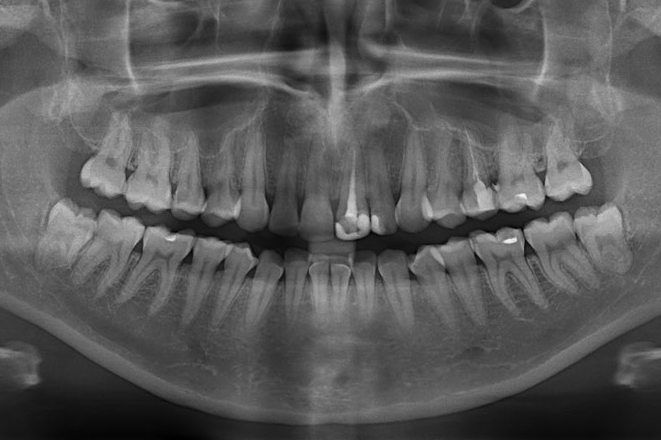 Ортопантомограмма зубов Сургут